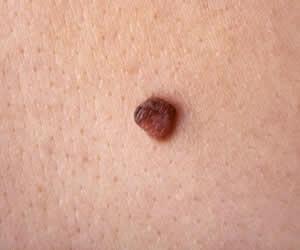 en-tehlikeli-cilt-kanseri-turu-olan-melanoma-mevcut-bir-benden-baslayabilir