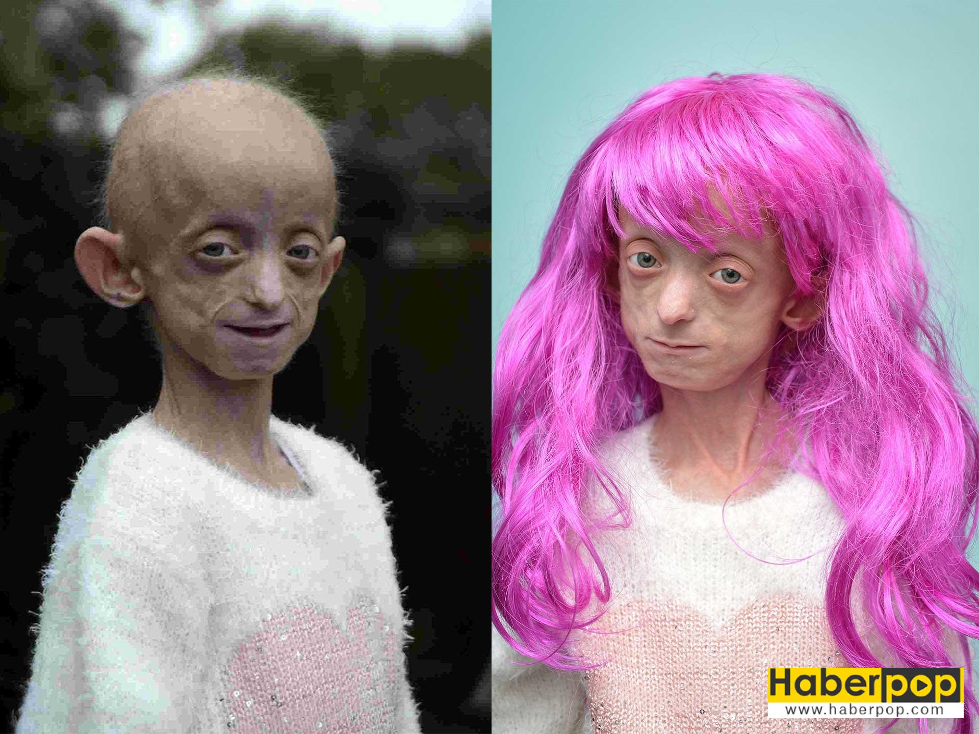 progeria-progeri-erken-yaslanma-hastaligi-nedir